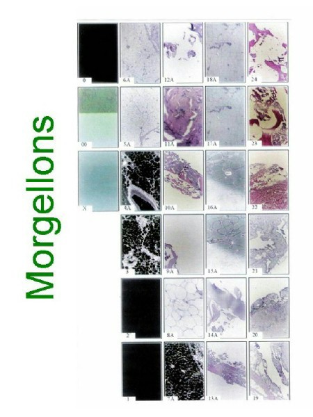 Morgellon Pathology Slides